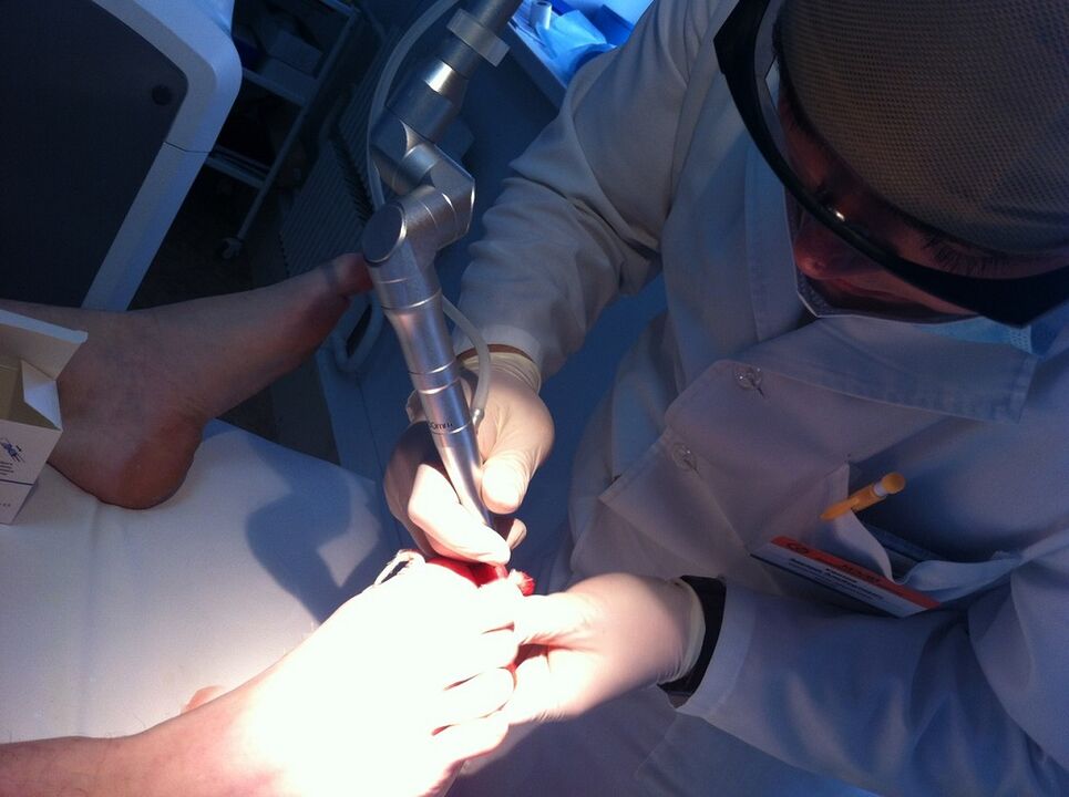 Tratamentul laser al micozei